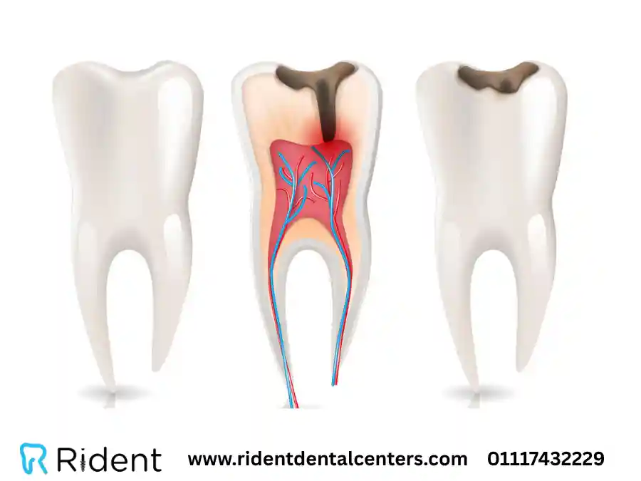 التهاب عصب الضرس
